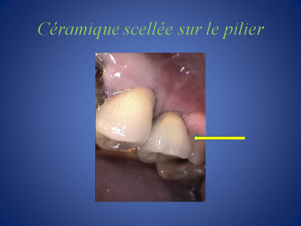 Couronne_unitaire_sur_implant-8