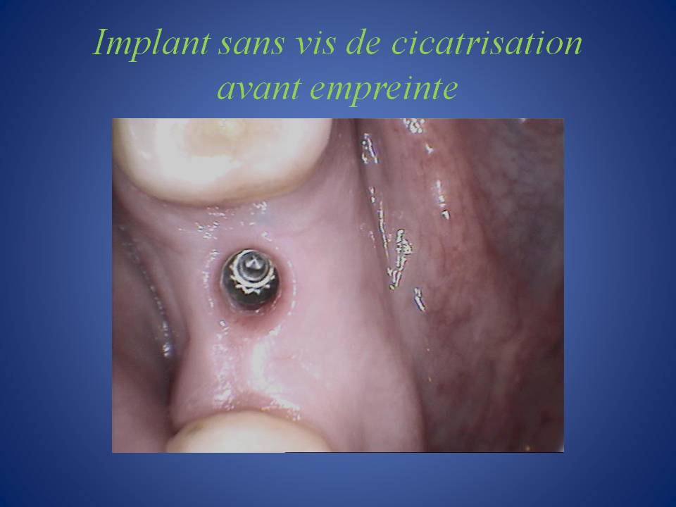 Couronne_unitaire_sur_implant-5