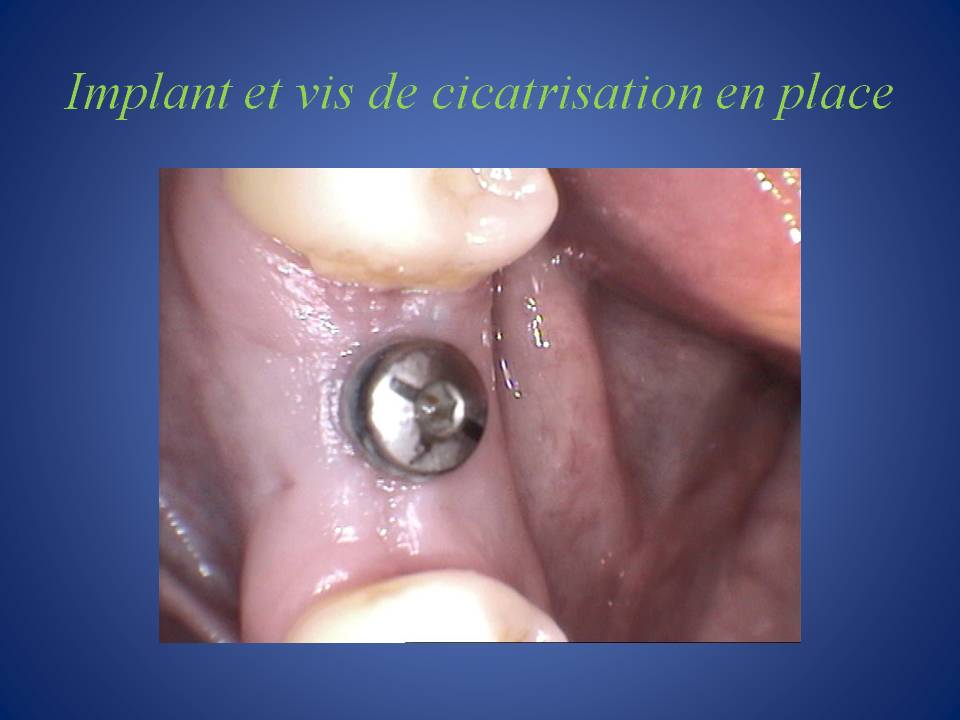 Couronne_unitaire_sur_implant-2