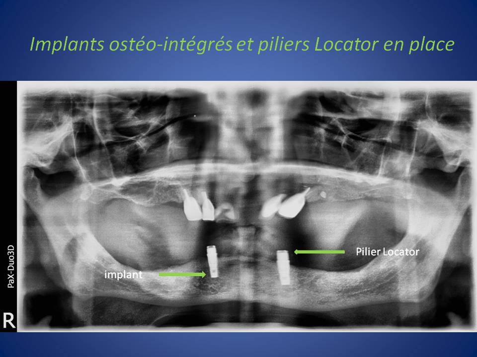 implants_Locator-2